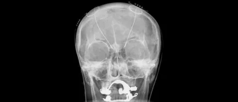 Elettrodi stimolazione cerebrale profonda